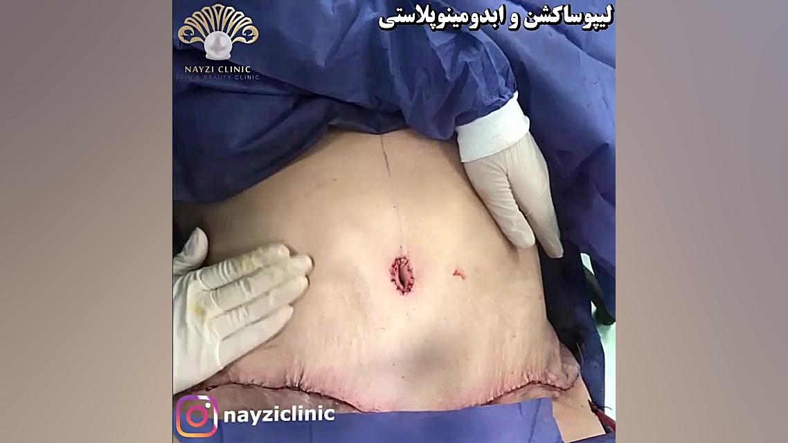 لیپوساکشن و ابدومینوپلاستی | مراجعه زیباجو عزیز برای انجام پیکرتراشی ترمیم لبخند لثه‌ای