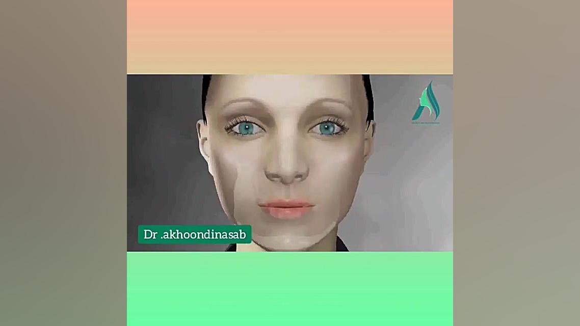 جراحی پروتز چانه دکتر محمدرضا آخوندی نسب-فوق تخصص جراحی پلاستیک