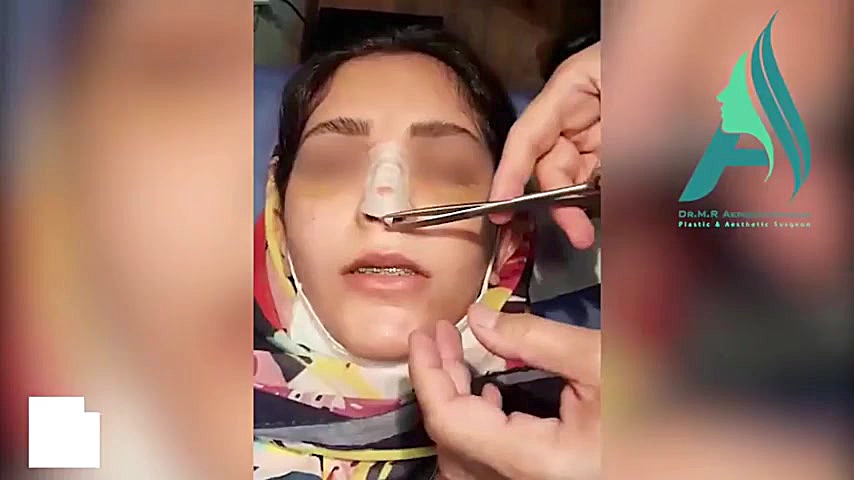 نحوه چسب زدن بینی و فرم نهایی چسب بینی دکتر محمدرضا آخوندی نسب-فوق تخصص جراحی پلاستیک