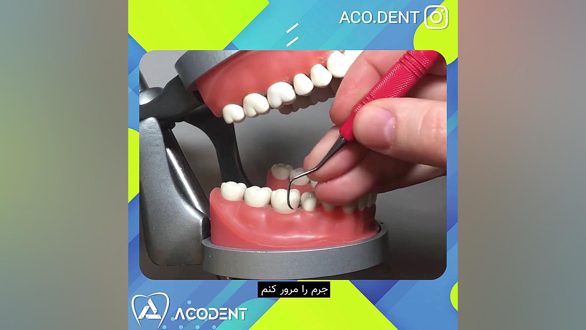 حرکات قلم جرمگیری برداشتن خال