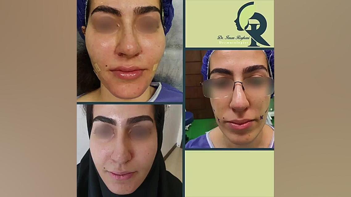 نتیجه تزریق چربی به صورت دکتر ایمان روغنی جراح و متخصص پوست و مو