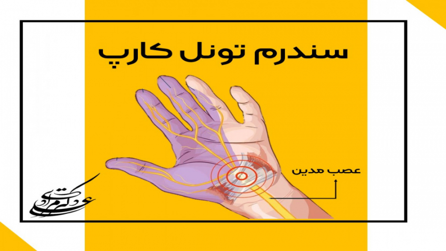 آزادسازی آرتروسکوپیک تونل کارپ Carpal Tunnel Syndrome دکتر علی مرادی جراح دست