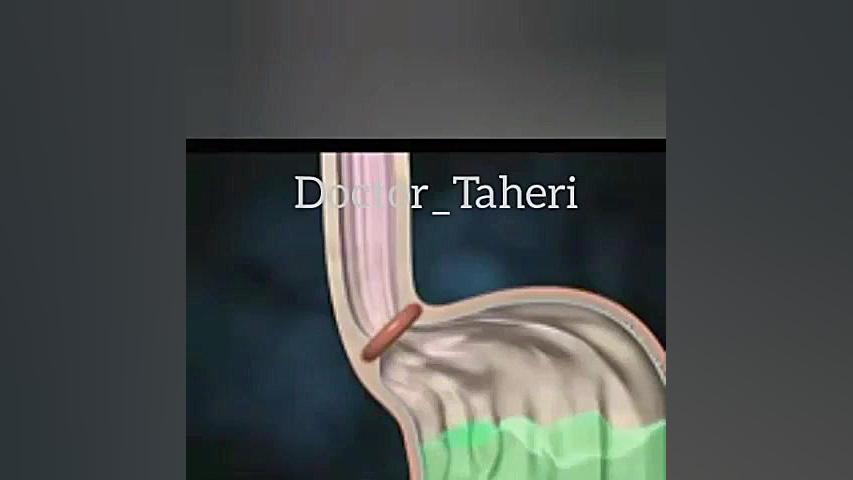 انیمیشن رفلاکس معده ترمیم دندان