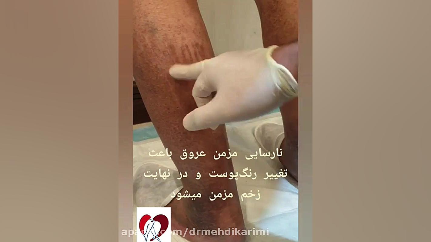 نارسایی مزمن عروق دکتر مهدی کریمی