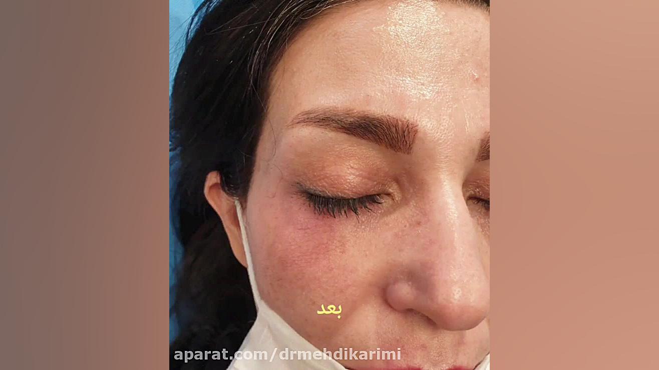 لیزر عروق واریسی زیر چشم دکتر مهدی کریمی