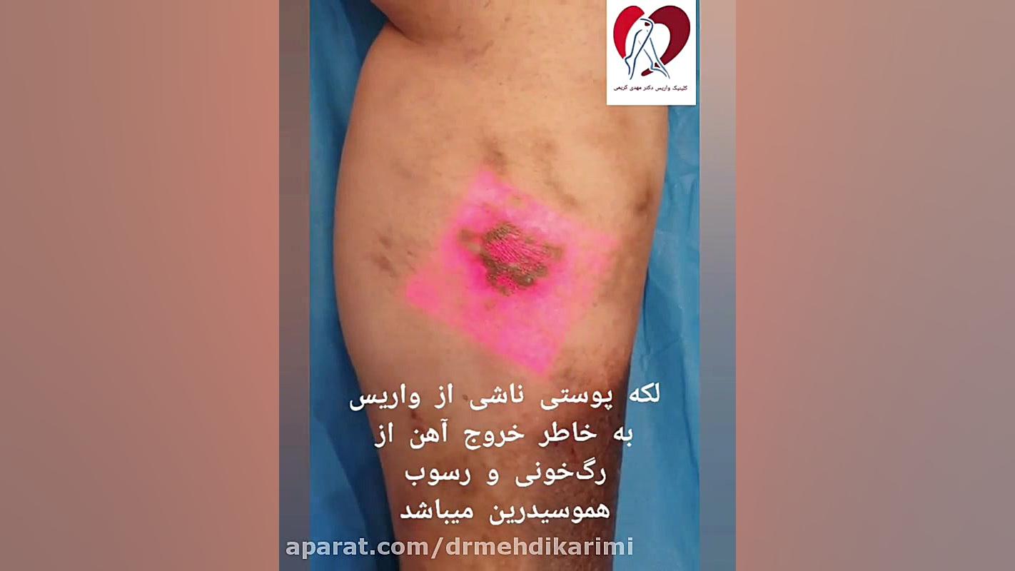 لکه های پوستی ناشی از واریس دکتر مهدی کریمی