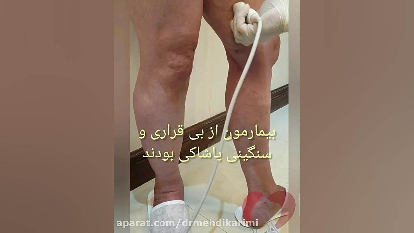 نتیجه عمل لیزر داخل رگ دکتر مهدی کریمی