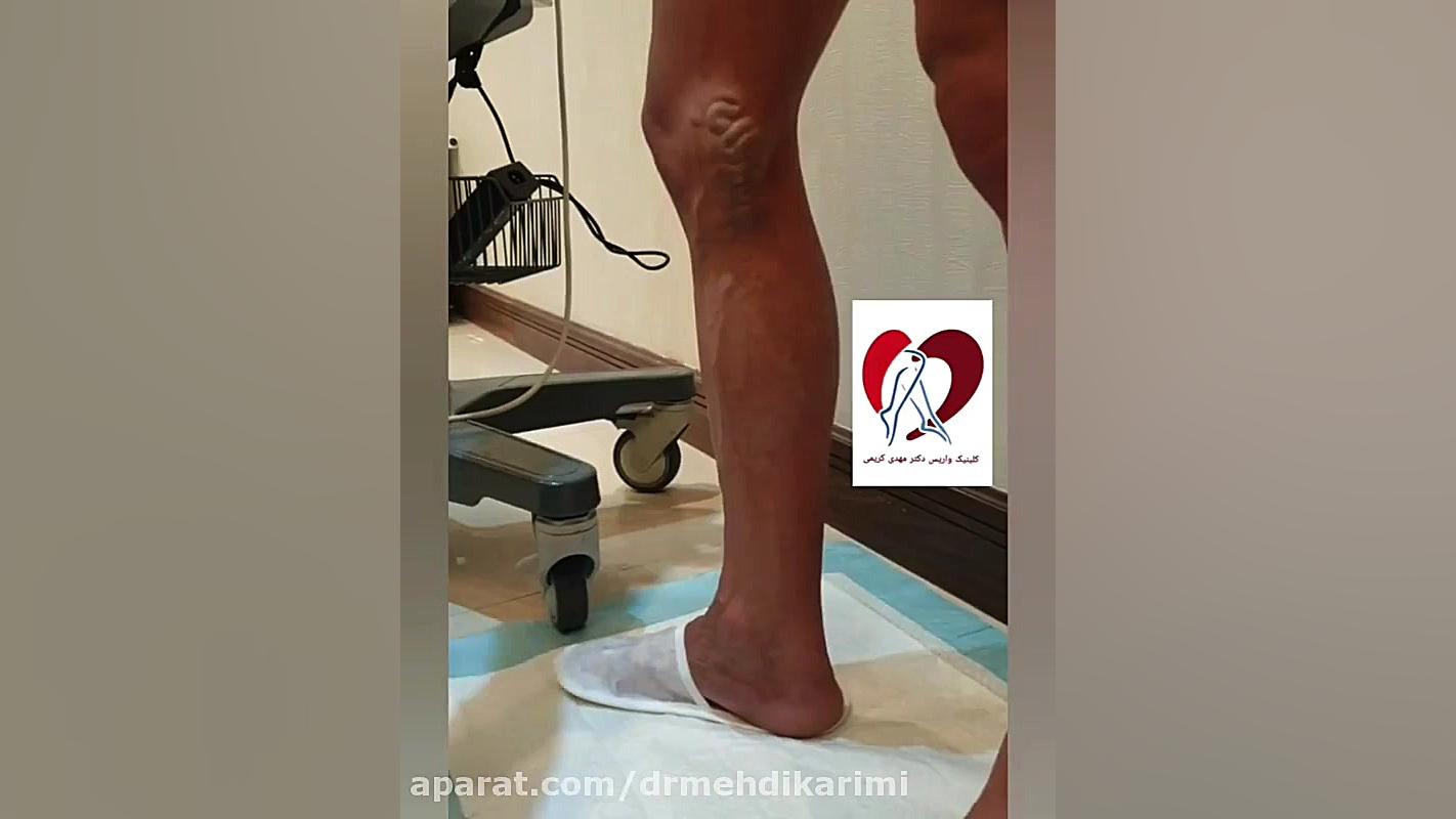 نتیجه عمل لیزر داخل رگ در جوان ورزشکار دکتر مهدی کریمی