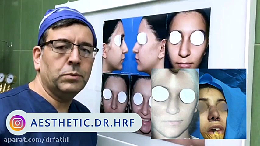 جراحی بینی به همراه لیفت لب دکتر حمید رضا فتحی فوق تخصص جراحی پلاستیک