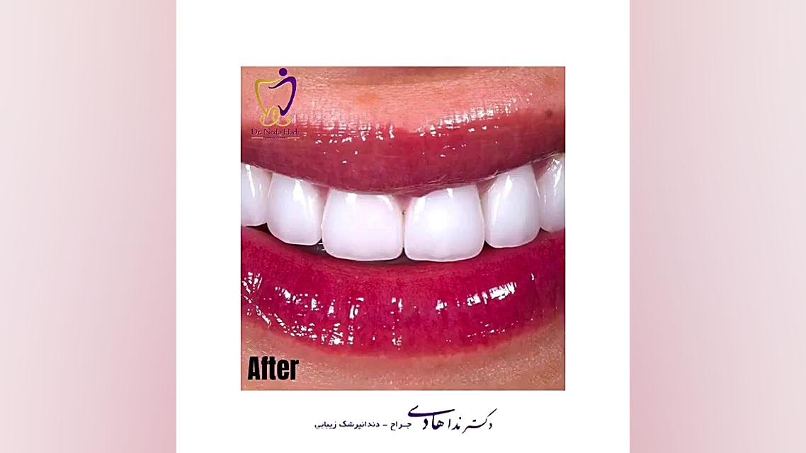 صاحب لبخندی زیبا باشید دکتر ندا هادی-دندانپزشک زیبایی