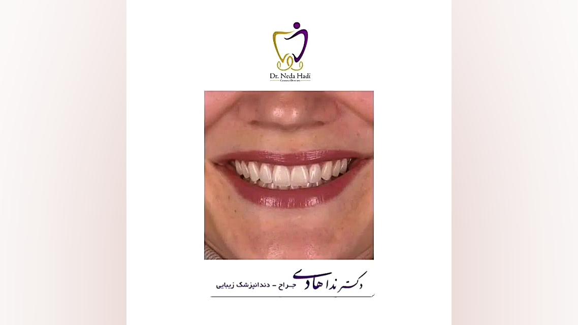 لبخند رضایتمندی مراجعه کننده دکتر ندا هادی-دندانپزشک زیبایی