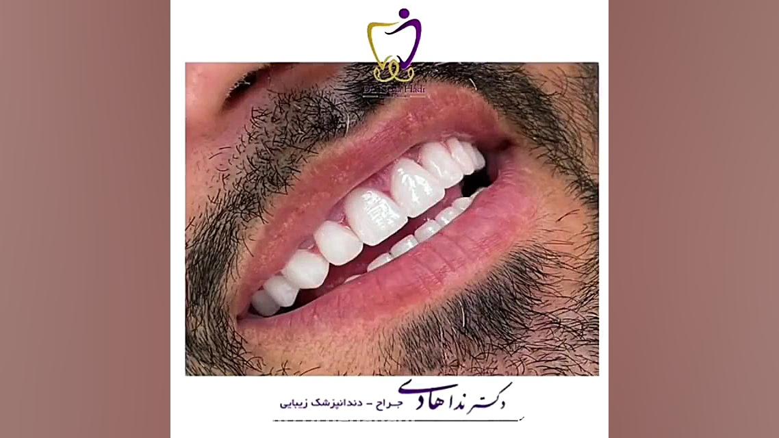 زیبایی دندان ها دکتر ندا هادی-دندانپزشک زیبایی