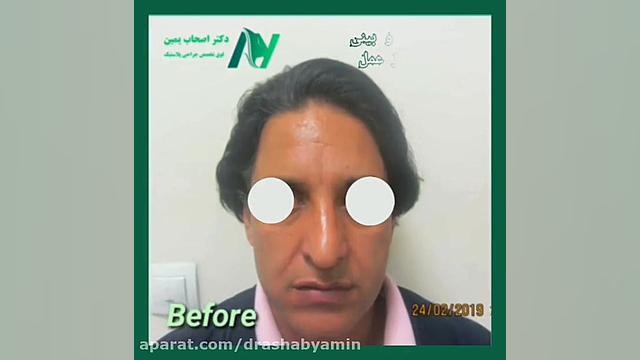 فیلم واقعی عمل بینی و لیفت پیشانی دکتر محمودرضا اصحاب یمین - فوق تخصص پلاستیک