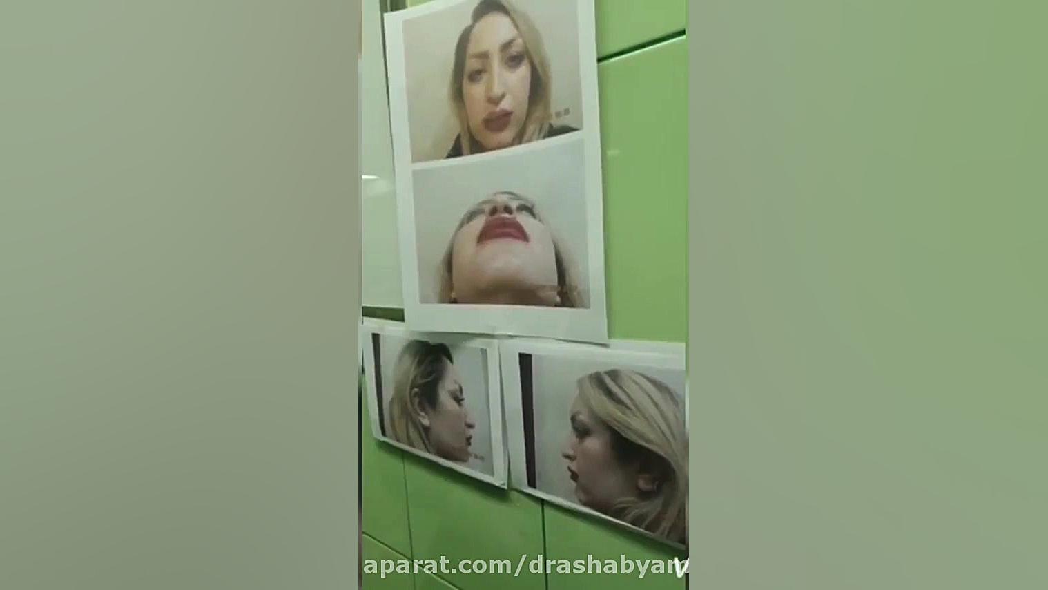 فیلم واقعی رینوپلاستی دکتر محمودرضا اصحاب یمین - فوق تخصص پلاستیک