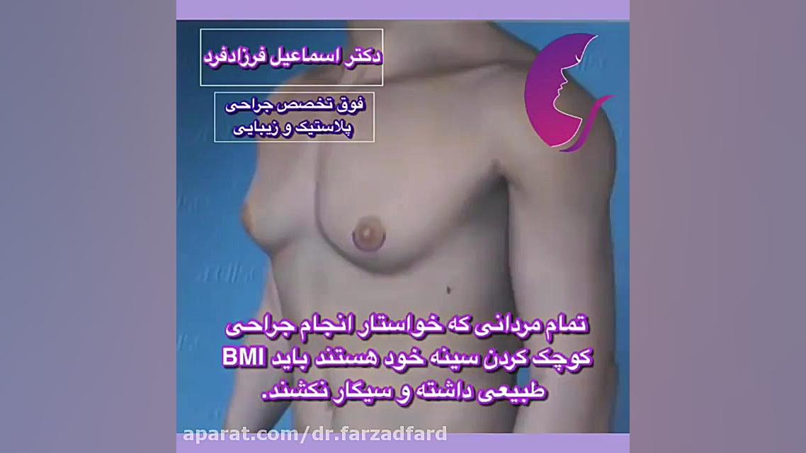 نکات جراحی ژنیکوماستی دکتر اسماعیل فرزاد فرد - فوق تخصص پلاستیک