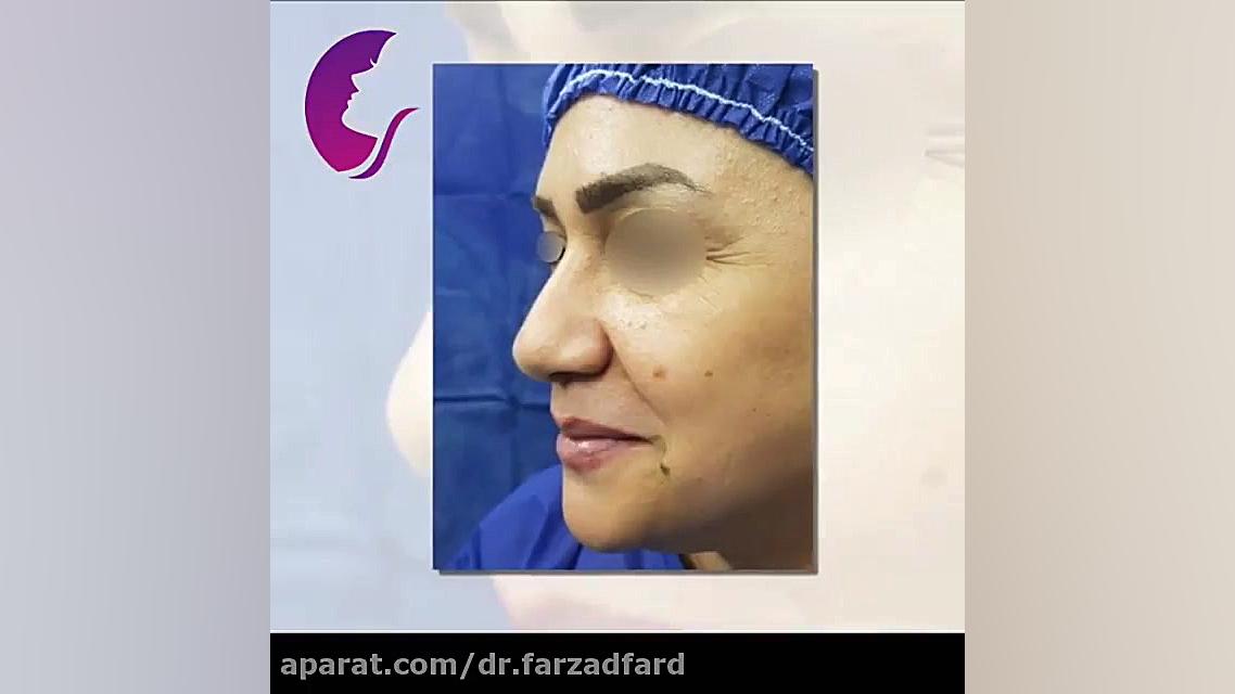جراحی بینی حین عمل دکتر اسماعیل فرزاد فرد - فوق تخصص پلاستیک