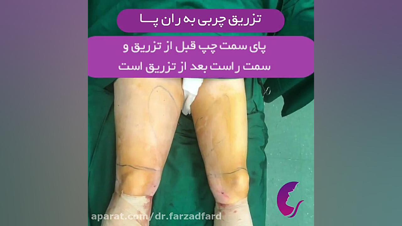 فیلم واقعی تزریق چربی به ران پا دکتر اسماعیل فرزاد فرد - فوق تخصص پلاستیک