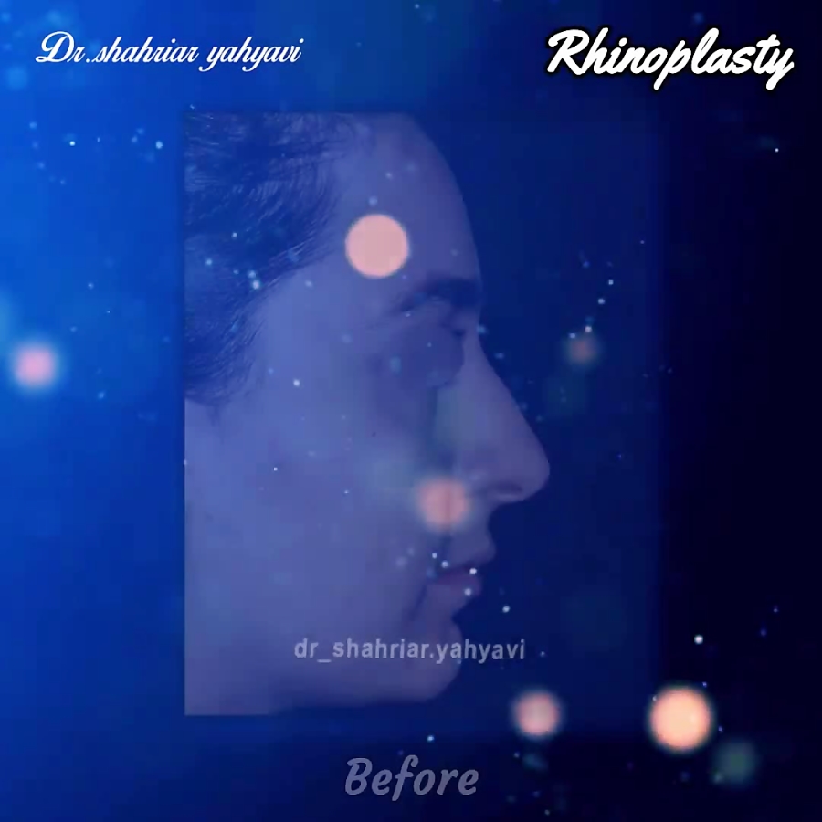 نمونه کار جراحی بینی
