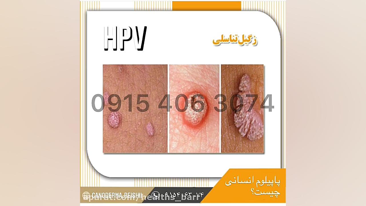 زگیل تناسلی یا پاپیلوم انسانی چیست؟ جنیفر لوپز