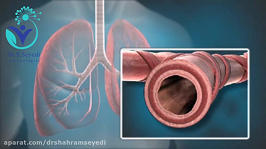 توضیحاتی درباره بیماری آسم دکتر شهرام سیدی متخصص آلرژی و ایمونولوژی