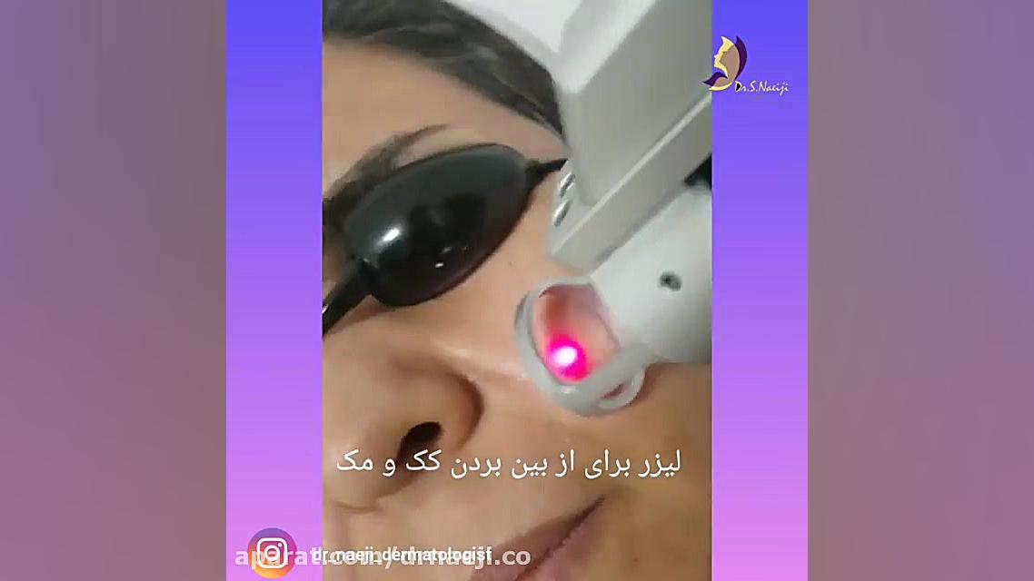 فیلم واقعی از بین بردن کک و مک با لیزر! دکتر صدیقه نائیجی | متخصص پوست و مو در قم