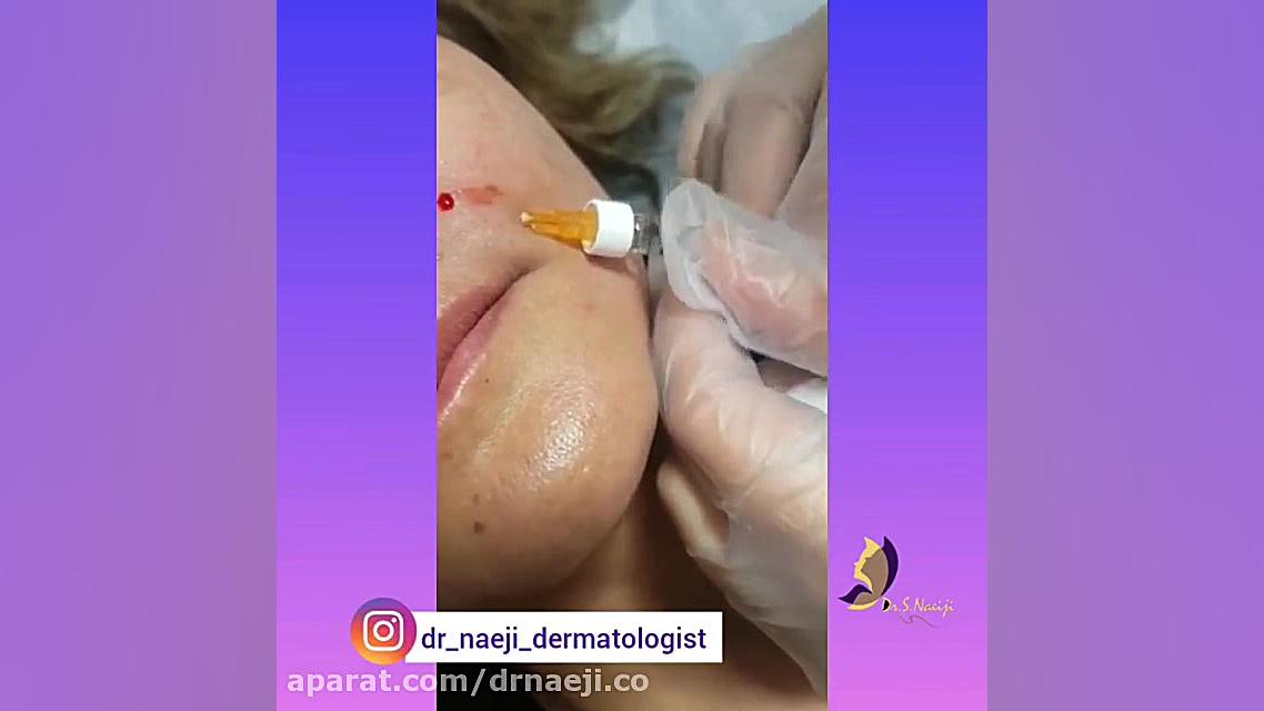 فیلم واقعی تزریق فیلر خنده در قم دکتر صدیقه نائیجی | متخصص پوست و مو در قم