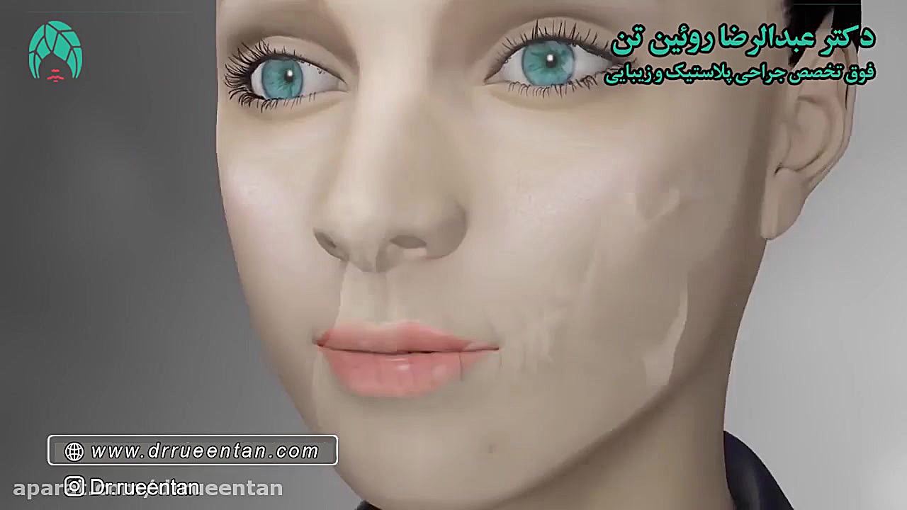 انیمیشن پروتز چانه دکتر عبدالرضا روئین تن