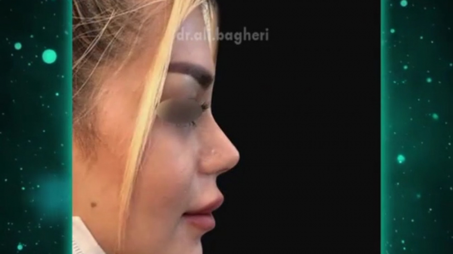قبل و بعد از جراحی بینی دکتر علی باقری حق