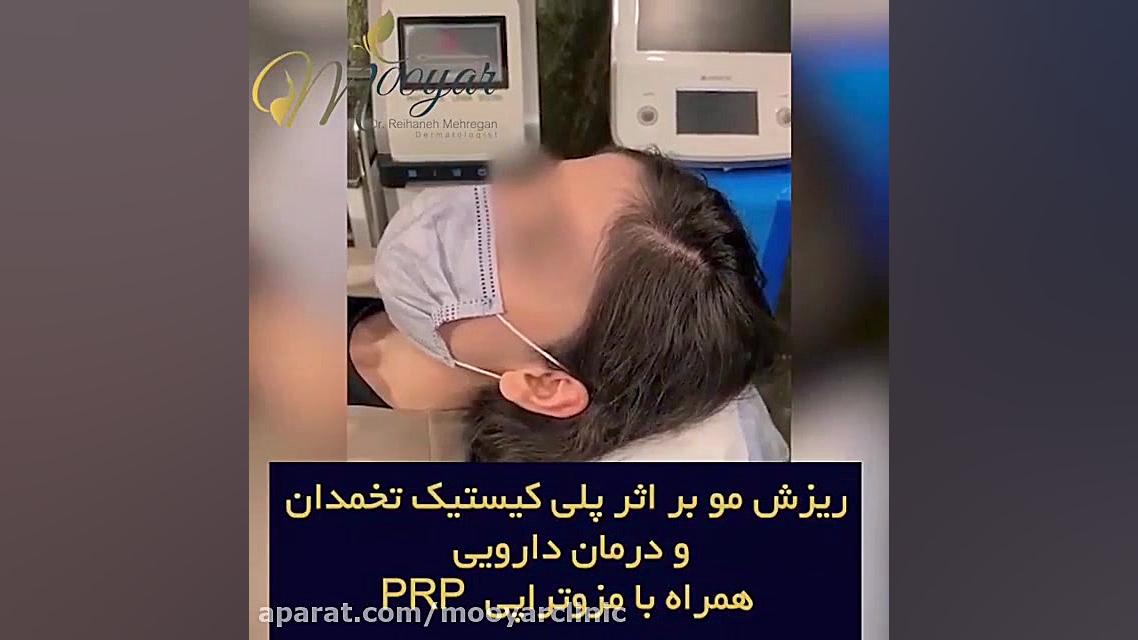درمان ریزش مو بر اثر پلی کیستیک تخمدان و درمان دارویی و همراه با مزوتراپی پیلینگ شیمیایی