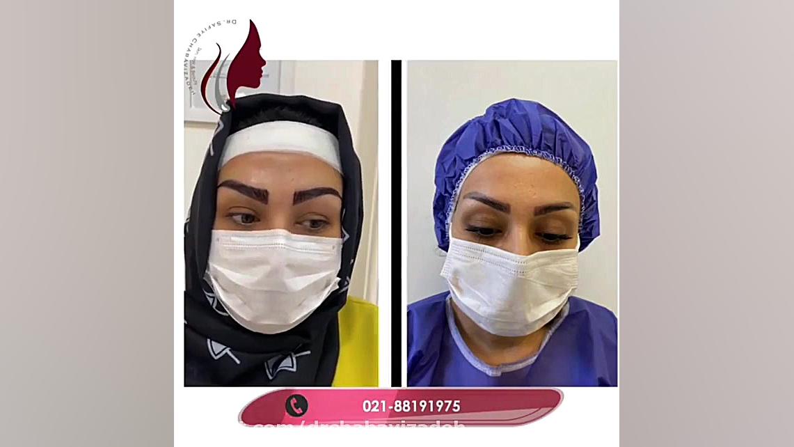 فیلم واقعی کاشت ابرو و رضایت مراجعه کننده از نتیجه دکتر صفیه چعباوی زاده