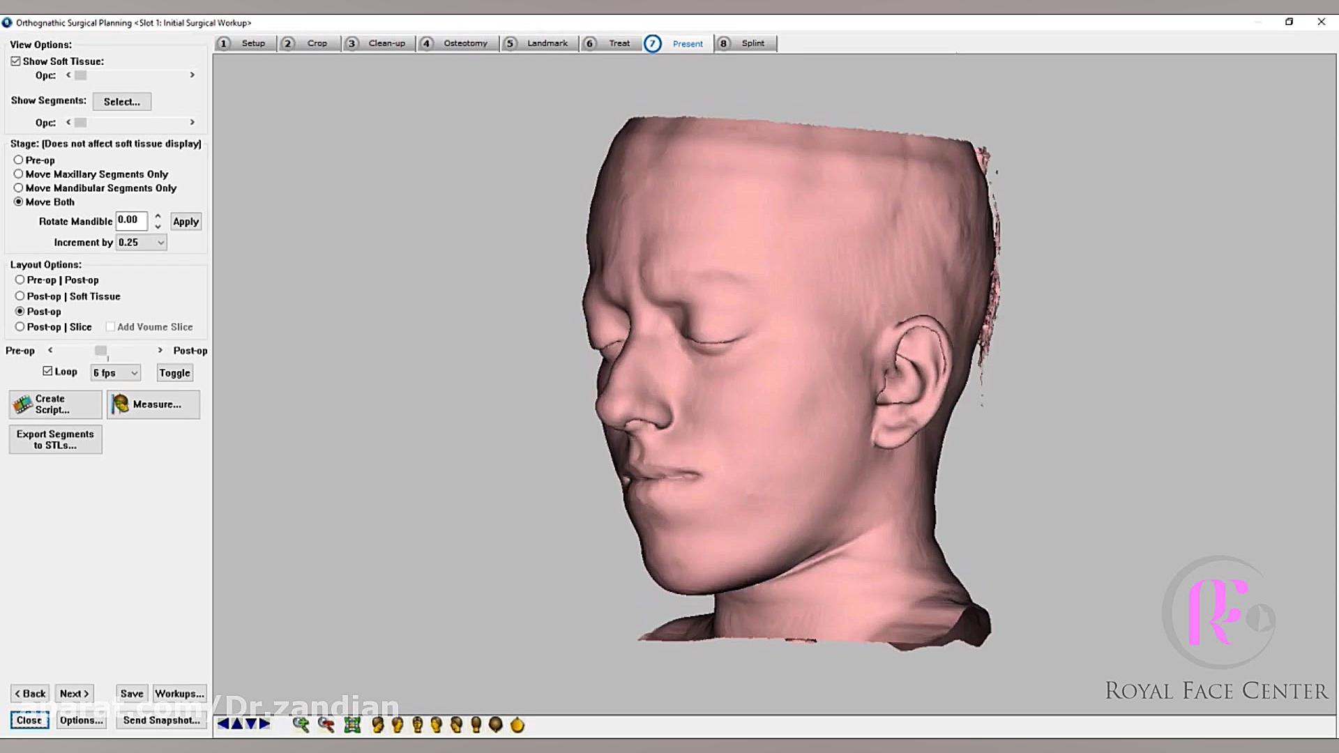 طراحی و پیش بینی نتایج جراحی بیمار ارتوسرجری دکتر دانا زندیان