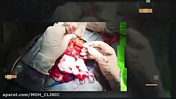 فیلم از نزدیک جراحی توده شقیقه