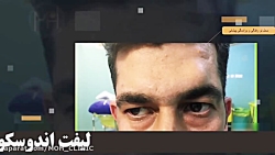 لیفت اندوسکوپی و برداشتن تومور...