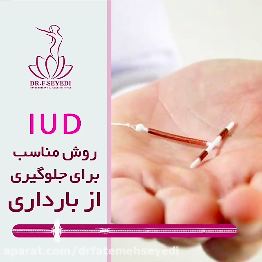 IUD بهترین روش برای جلوگیری از بارداری