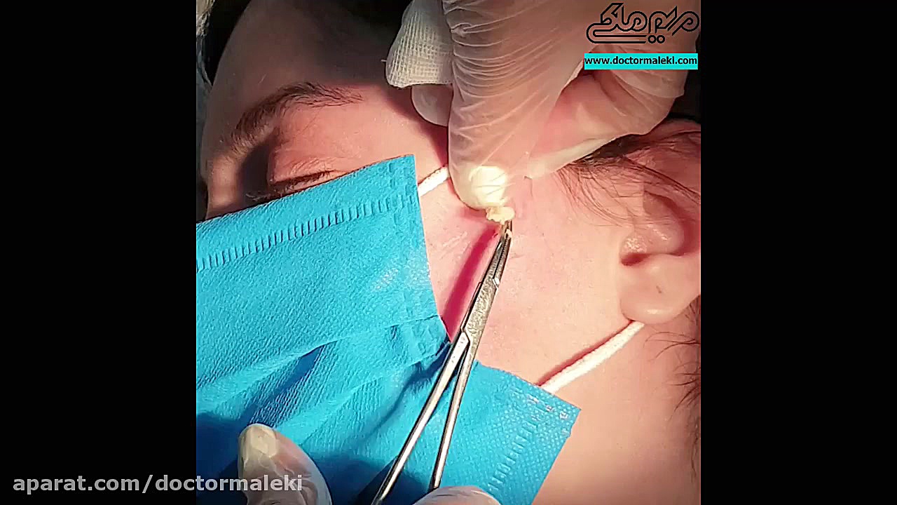 تخلیه کیست اپیدرمال دکتر مریم ملکی - کلینیک پوست و مو و زیبایی هور