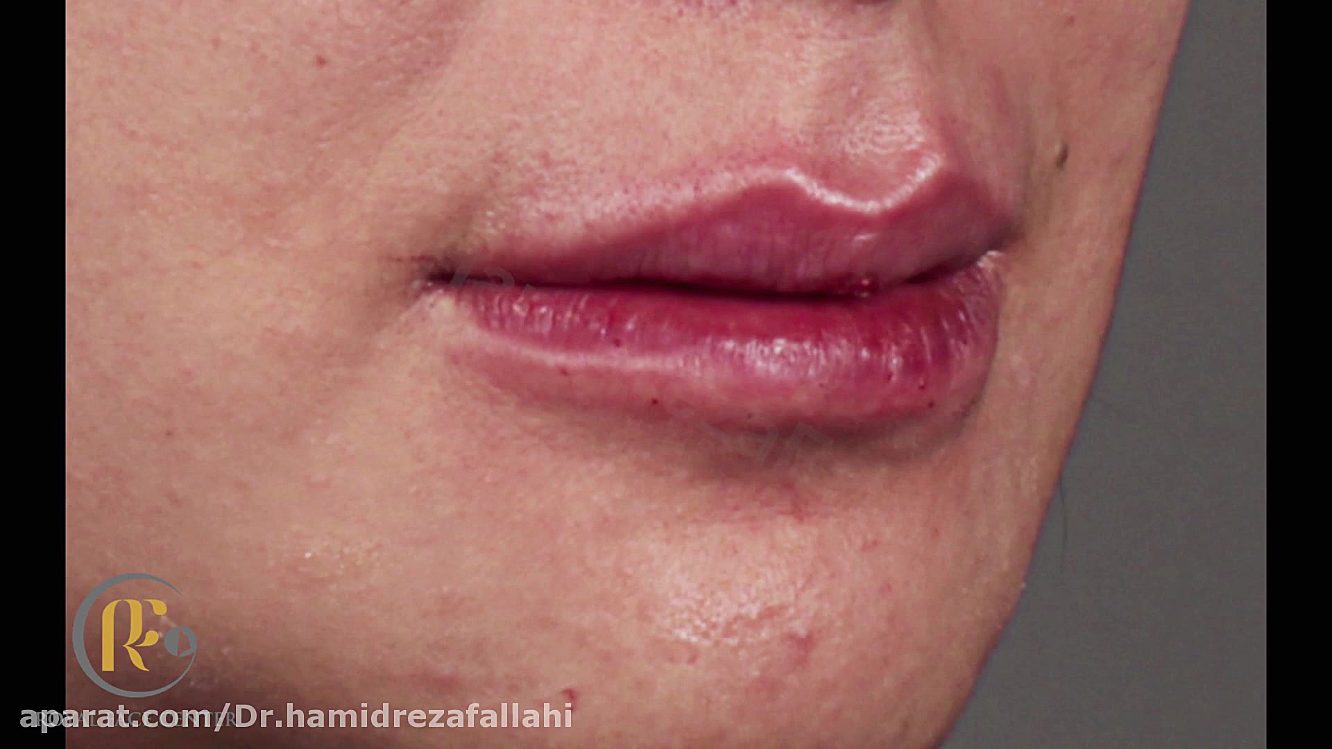 تصاویر ژل لب دکتر حمیدرضا فلاحی