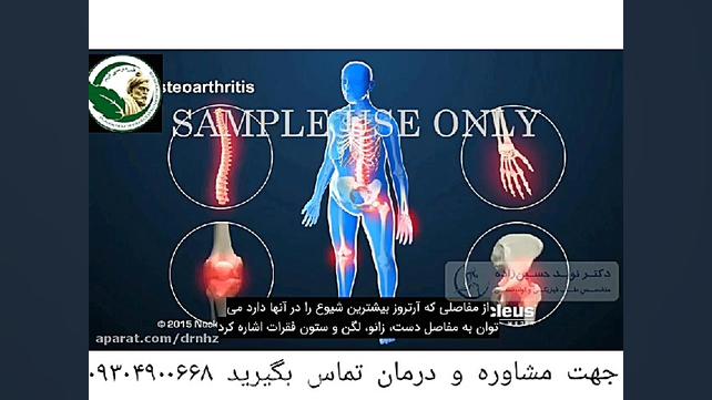 آرتروز زانو چیست؟ علائم و درمان آن کوبی برایانت