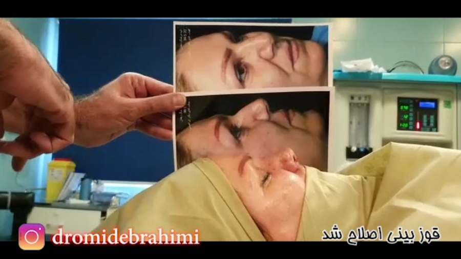 جراحی انحراف بینی و برطرف کردن قوز بینی توسط دکتر امید ابراهیمی دکتر امید ابراهیمی