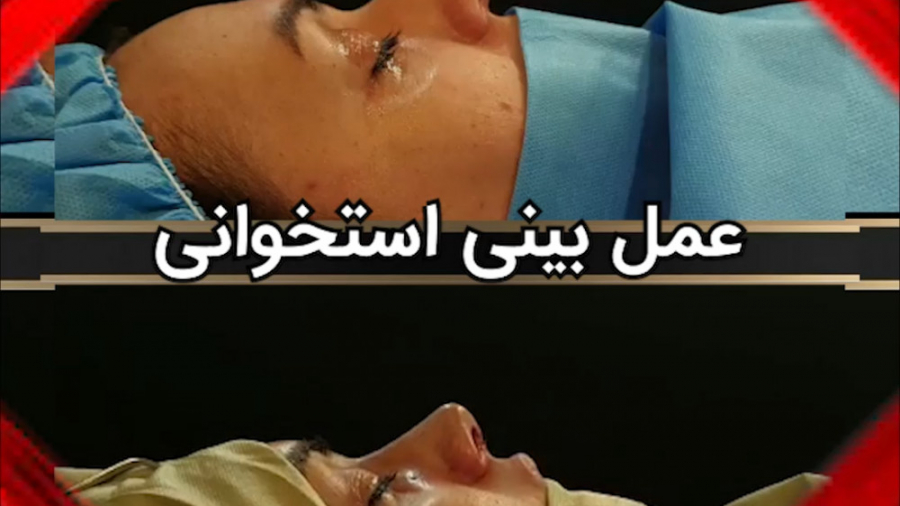 عمل زیبایی بینی توسط دکتر امید ابراهیمی بهترین جراح بینی در تهران دکتر امید ابراهیمی
