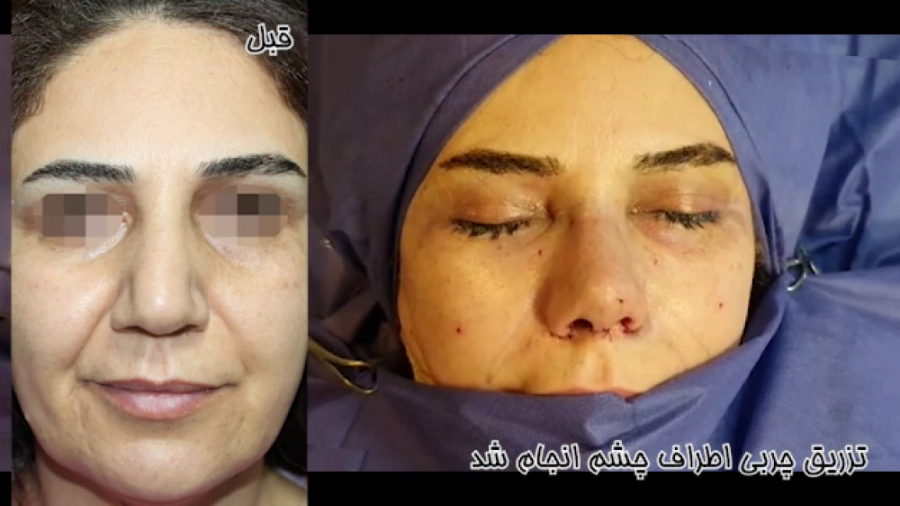 عمل بینی گوشتی به همراه ساکشن غبغب و تزریق چربی توسط دکتر امید ابراهیمی دکتر امید ابراهیمی