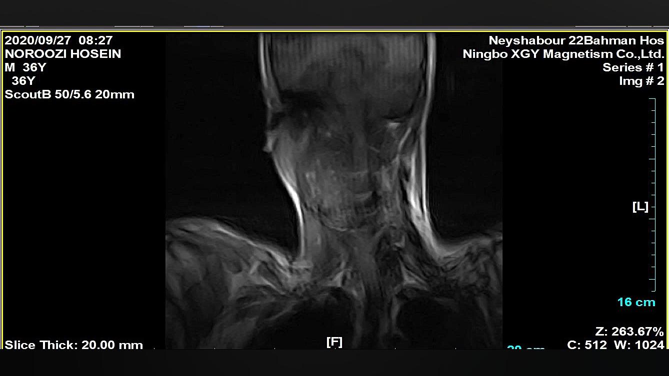 فیلم mri یک فرد مبتلا به درد گردن کربوکسی تراپی