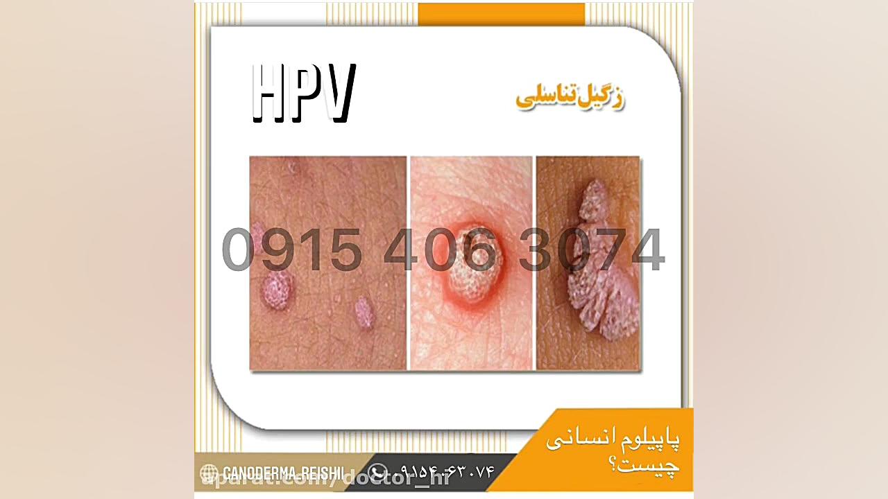 ویروس پاپیلوم انسانی HPV بلاگر
