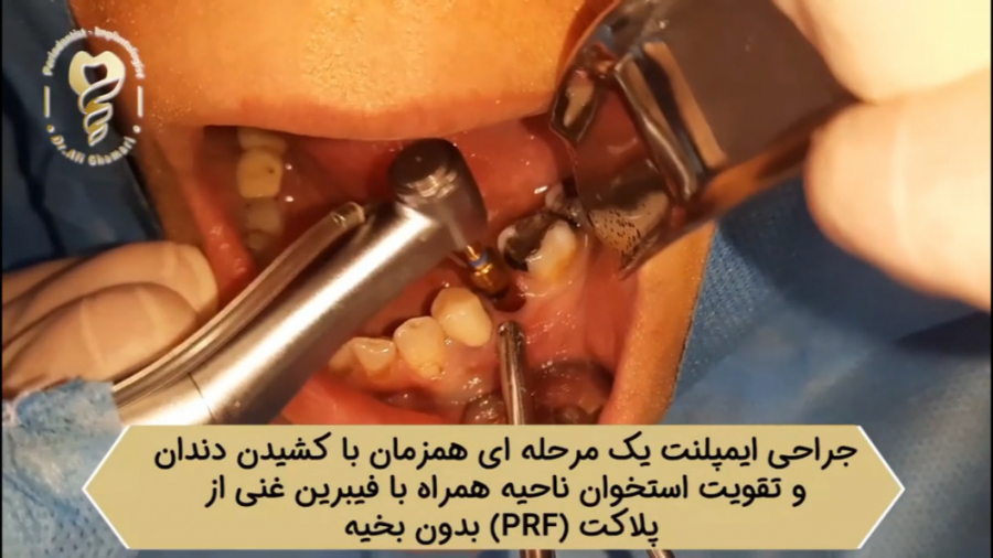 فیلم واقعی جراحی ایمپلنت همزمان با کشیدن دندان ها دکتر علی قمری - متخصص جراحی لثه و ایمپلنت