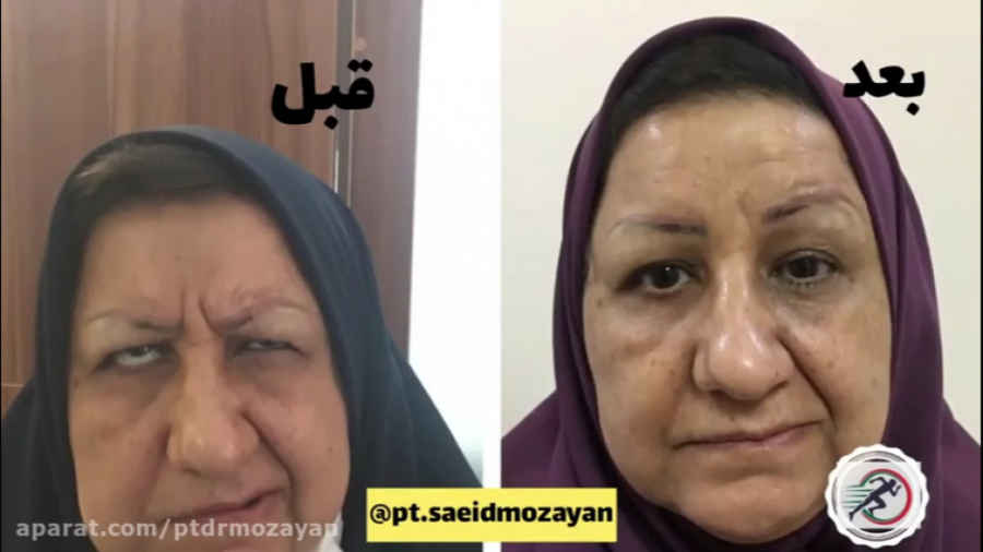 درمان موفق فلج بلز راجعه توسط فیزیوتراپی دکتر مزین دندانپزشکی کودکان