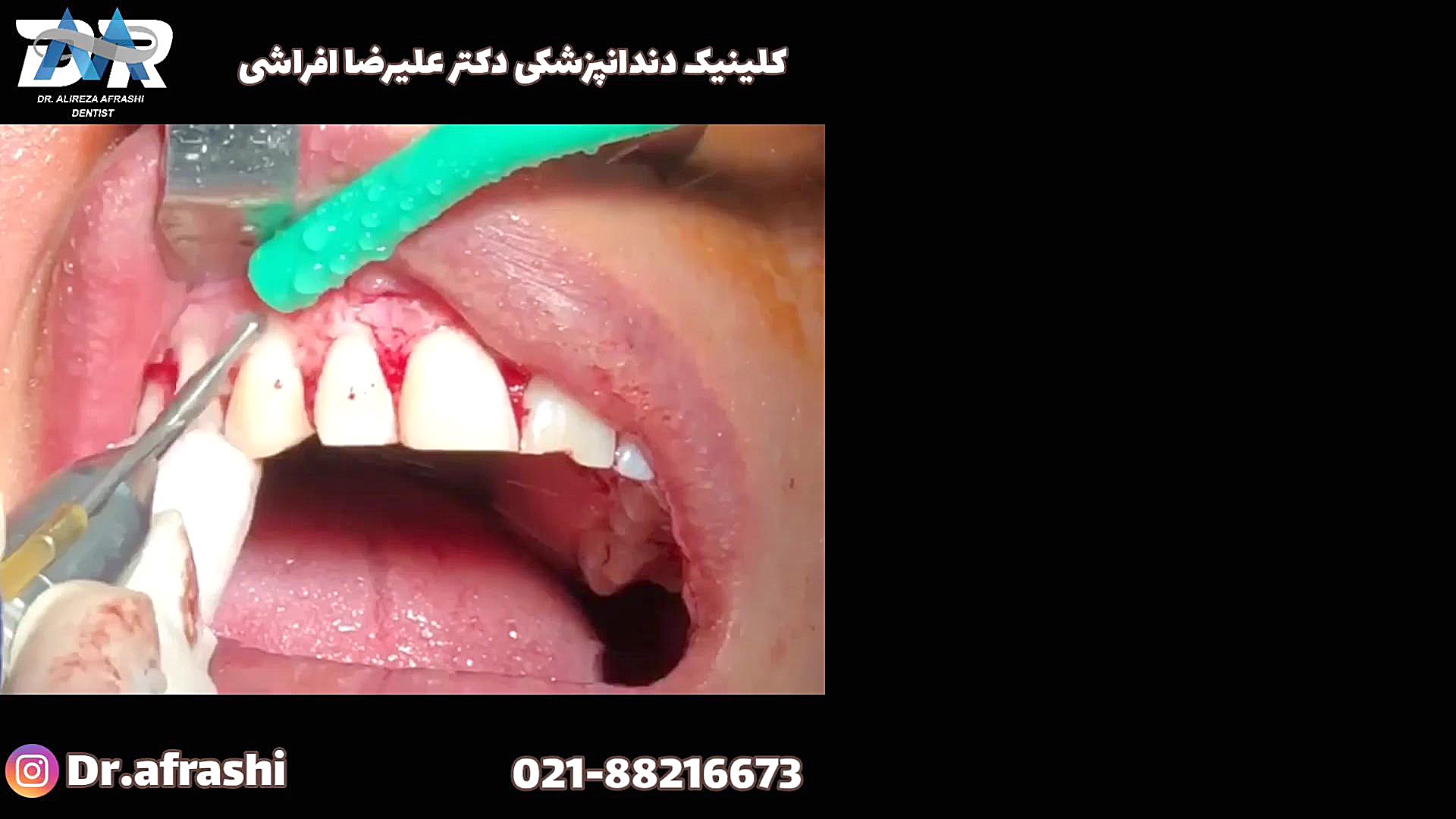 جراحی لثه (لبخند لثه ای) دستگاه آنالیز ایمیجینگ سلول زنده