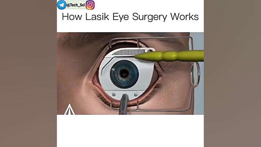 نحوه عمل لیزیک دکترحمیدنادی جراح ومتخصص چشم لیپوماتیک