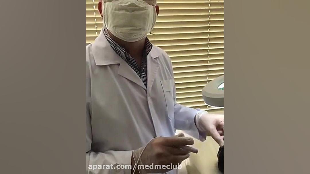 برداشتن خال در مجموعه Med Me Club ASO Test