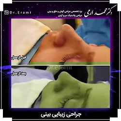جراحی زیبایی بینی | متخصص گوش...