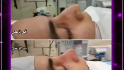 جراحی بینی توسط دکتر محمد ارمی