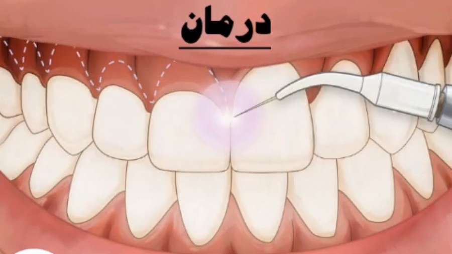 لبخند لثه ای - دلایل لبخند لثه ای - درمان لبخند لثه ای TAVI